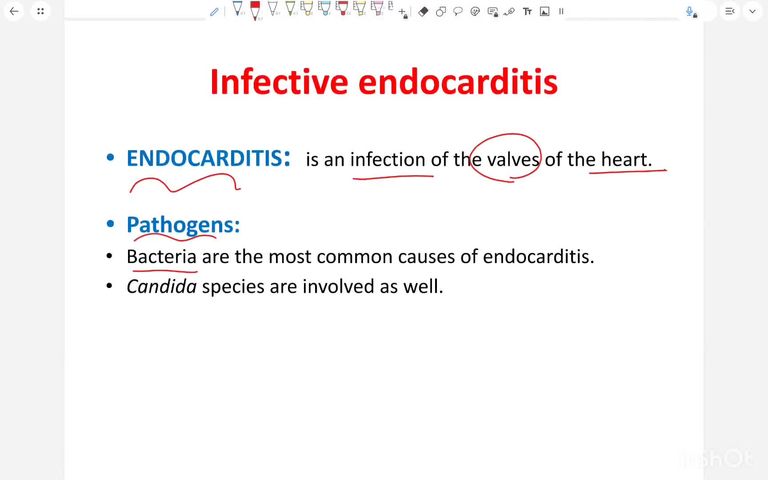Infective endocarditis A