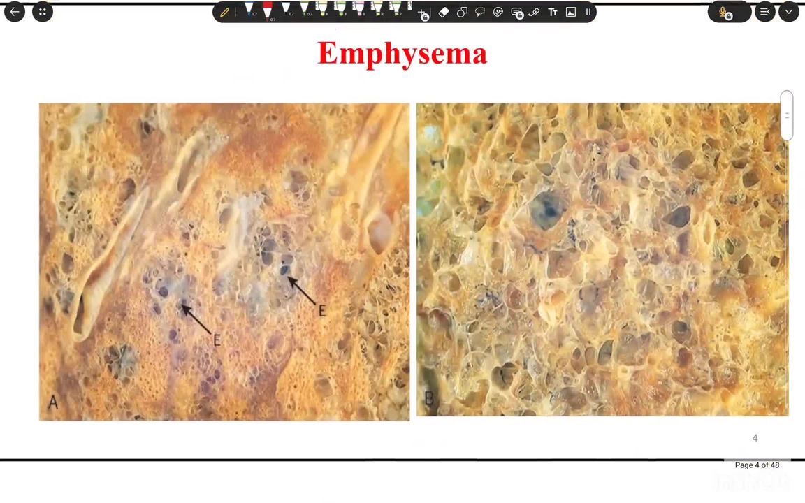 Respiratory diseases
