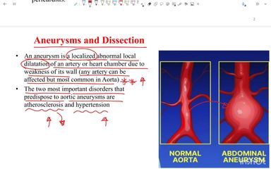 Aneurysms