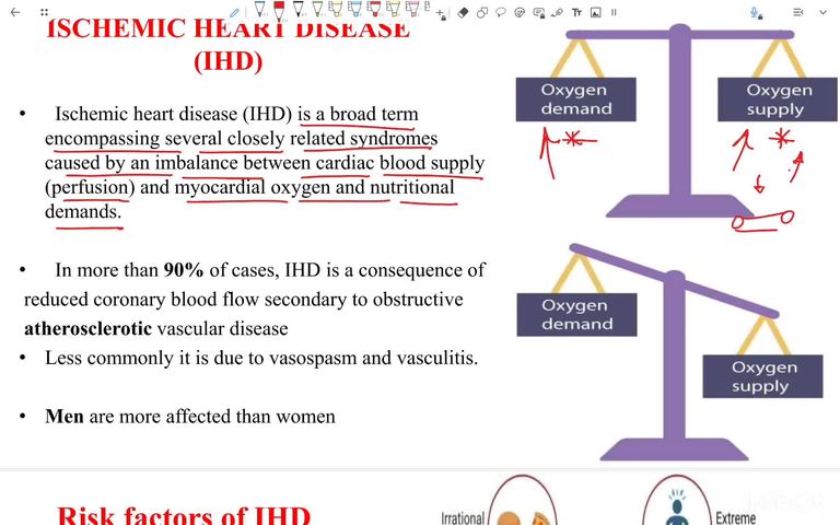 Myocardial infarction