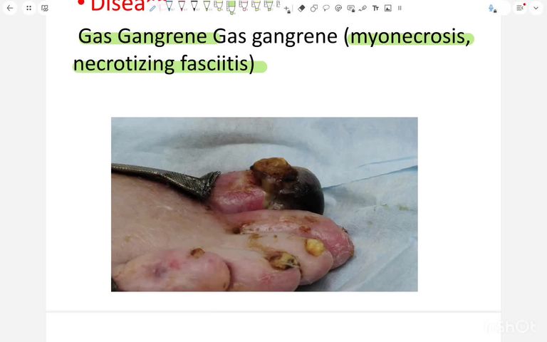 wound infection
