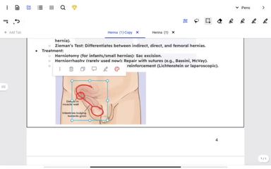 General surgery part 2 Hernia