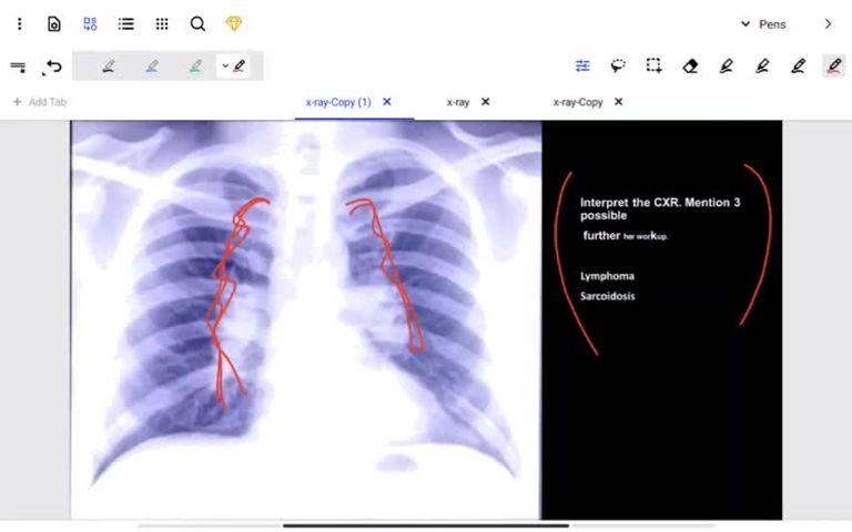 Chest X-ray part 2