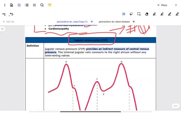 JVP and acute pericarditis