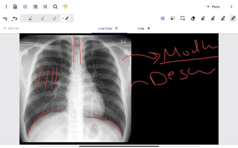 Chest xray part 1