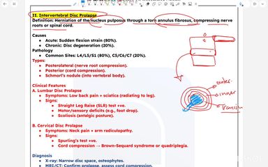 intervertebral disc prolapse